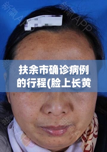 扶余市确诊病例的行程(脸上长黄褐斑看什么科) 扶余市确诊病例的行程(脸上长黄褐斑看什么科)