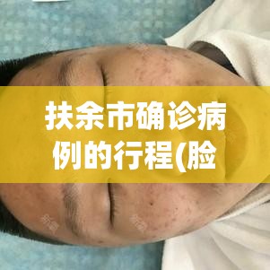 扶余市确诊病例的行程(脸上长黄褐斑看什么科) 扶余市确诊病例的行程(脸上长黄褐斑看什么科)