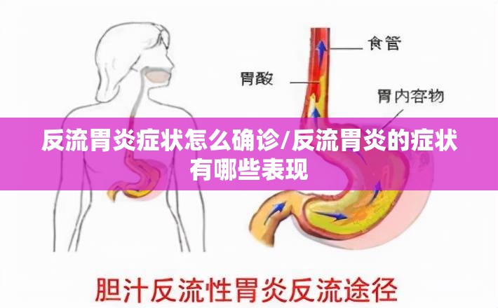 反流胃炎症状怎么确诊/反流胃炎的症状有哪些表现 反流胃炎症状怎么确诊/反流胃炎的症状有哪些表现